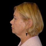 Neck Lift Before & After Patient #2733