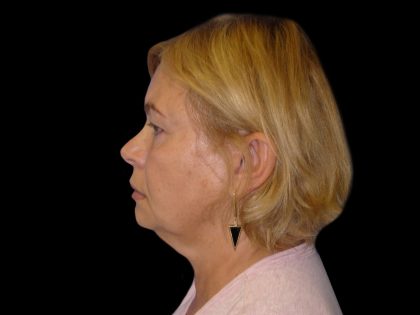 Neck Lift Before & After Patient #2733