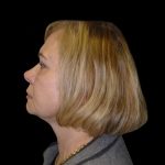 Neck Lift Before & After Patient #2733