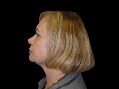 Neck Lift Before & After Patient #2733