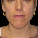 Neck Lift Before & After Patient #2740