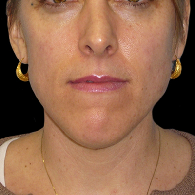 Neck Lift Before & After Patient #2740