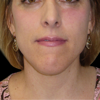 Neck Lift Before & After Patient #2740