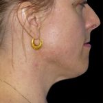 Neck Lift Before & After Patient #2740