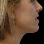 Neck Lift Before & After Patient #2740