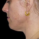 Neck Lift Before & After Patient #2740