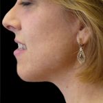 Neck Lift Before & After Patient #2740