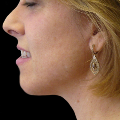 Neck Lift Before & After Patient #2740