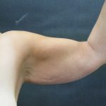 Arm Lift Before & After Patient #888