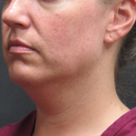 Fat Transfer Before & After Patient #1789