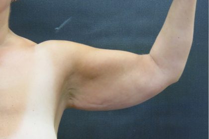 Arm Lift Before & After Patient #888