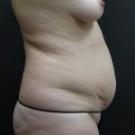 Mommy Makeover Before & After Patient #2657