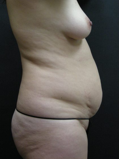 Mommy Makeover Before & After Patient #2657