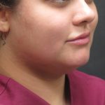 Scarless Facelift and Necklift Before & After Patient #3028
