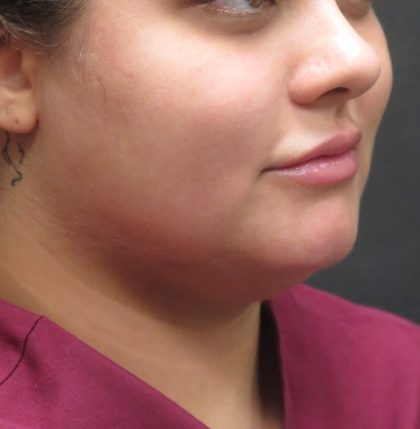 Scarless Facelift and Necklift Before & After Patient #3028