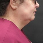 Scarless Facelift and Necklift Before & After Patient #3049
