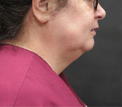 Scarless Facelift and Necklift Before & After Patient #3049