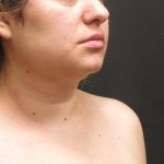 Scarless Facelift and Necklift Before & After Patient #3067