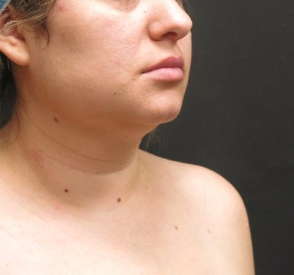Scarless Facelift and Necklift Before & After Patient #3067