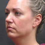 Scarless Facelift and Necklift Before & After Patient #3101