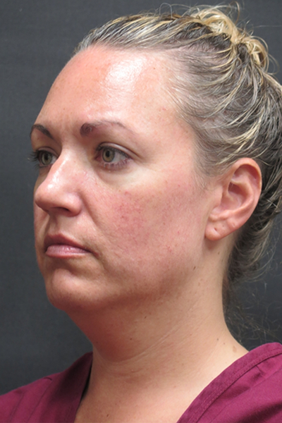 Scarless Facelift and Necklift Before & After Patient #3101