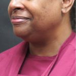 Scarless Facelift and Necklift Before & After Patient #1910