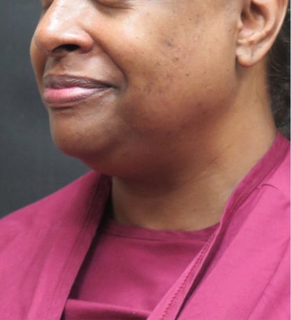 Scarless Facelift and Necklift Before & After Patient #1910