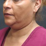 Scarless Facelift and Necklift Before & After Patient #3081