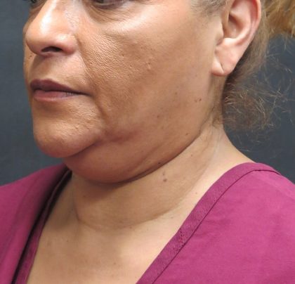 Scarless Facelift and Necklift Before & After Patient #3081