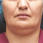 Scarless Facelift and Necklift Before & After Patient #3094