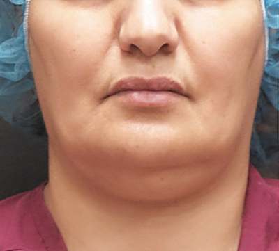Scarless Facelift and Necklift Before & After Patient #3094