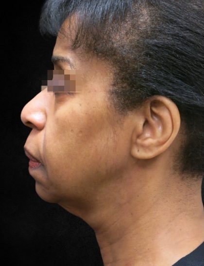 Fat Transfer Before & After Patient #1770