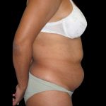 Tummy Tuck Before & After Patient #3146