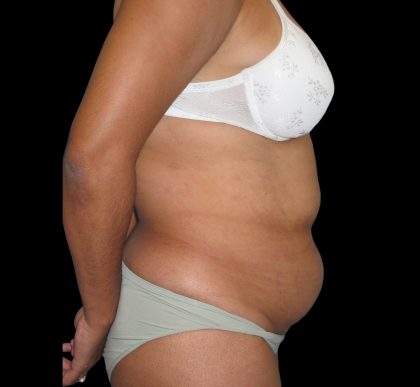Tummy Tuck Before & After Patient #3146