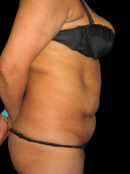 Tummy Tuck Before & After Patient #3155
