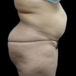 Tummy Tuck Before & After Patient #3166