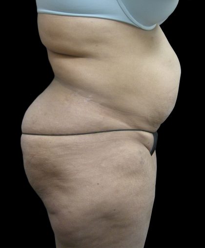 Tummy Tuck Before & After Patient #3166