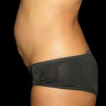 Tummy Tuck Before & After Patient #3175