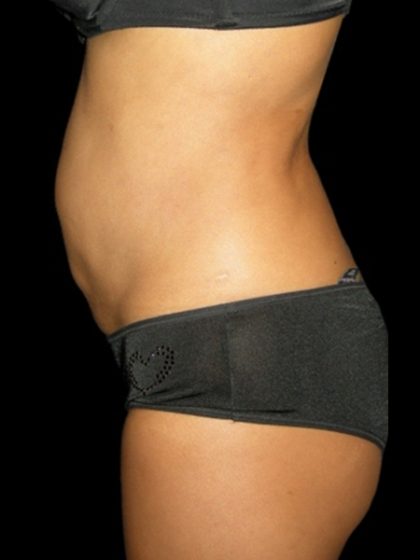 Tummy Tuck Before & After Patient #3175