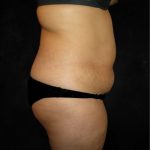 Tummy Tuck Before & After Patient #3186