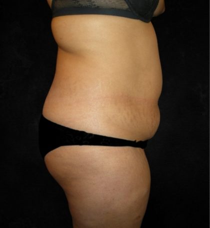 Tummy Tuck Before & After Patient #3186