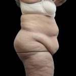 Tummy Tuck Before & After Patient #3209