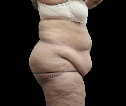 Tummy Tuck Before & After Patient #3209
