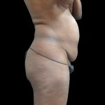 Tummy Tuck Before & After Patient #3216