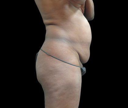 Tummy Tuck Before & After Patient #3216