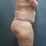 Tummy Tuck Before & After Patient #3225