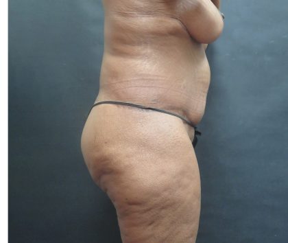 Tummy Tuck Before & After Patient #3225