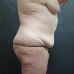 Tummy Tuck Before & After Patient #3245