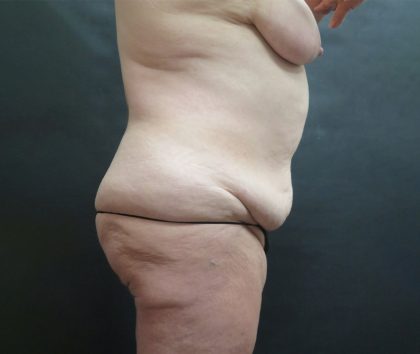 Tummy Tuck Before & After Patient #3245