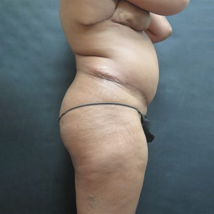 Tummy Tuck Before & After Patient #3254